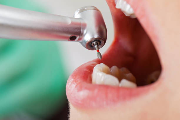 Best Emergency Wisdom Teeth Removal in Gang Mills, NY